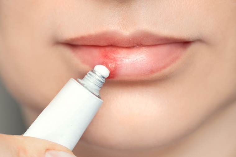 Calentura labial o Herpes labial - Clínica Dental Adeslas