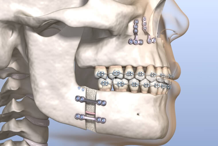 Todo sobre la cirugía ortognática - Clínica Dental Adeslas