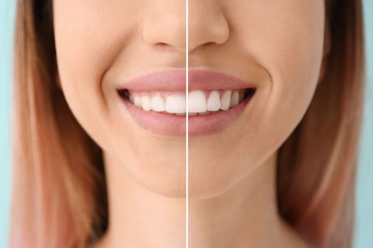 Todo sobre la gingivectomía - Clínica Dental Adeslas