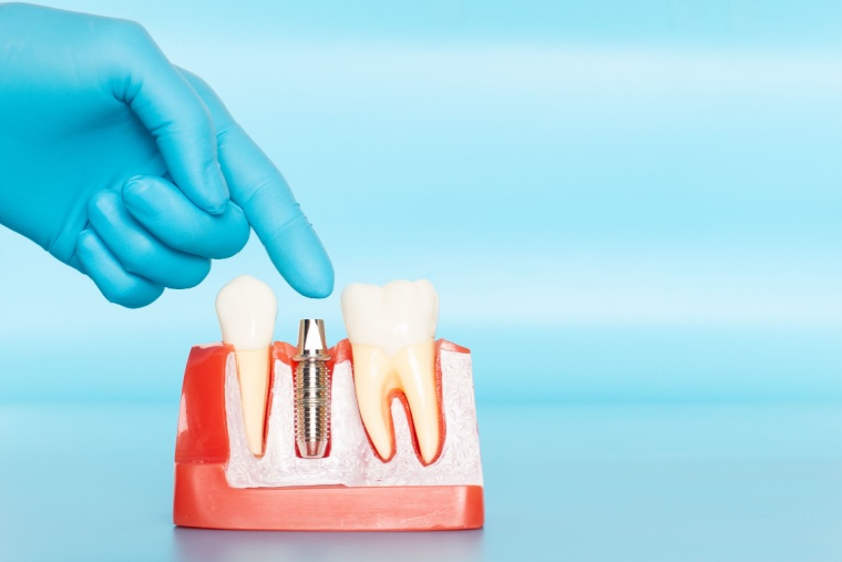 Història i evolució dels implants dentals - Clínica Dental Adeslas