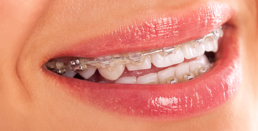 Self-ligating Brackets: Advantages And Price - Adeslas Dental